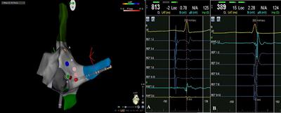 Zero Fluoroscopy Arrhythmias Catheter Ablation: A Trend Toward More Frequent Practice in a High-Volume Center